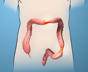 Irritable-bowel-syndrome