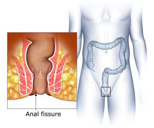 anal-fissure