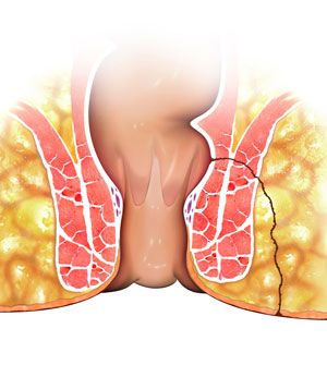 anal-fistula