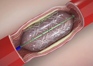 Angioplasty and Stents