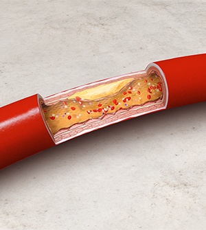 Atherosclerosis