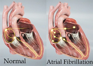 Atrial Fibrillation