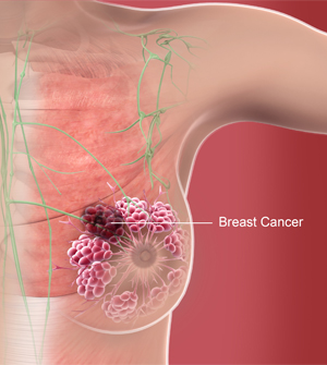Breast Awareness and Early Detection