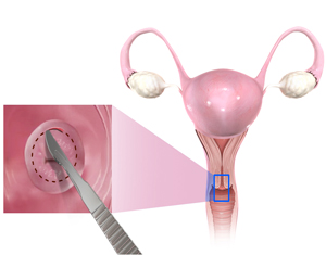 Cervical Biospy