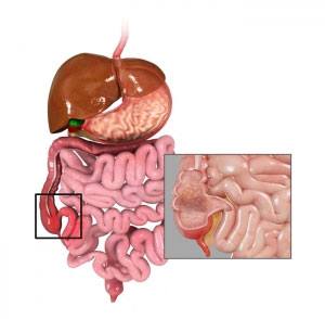 crohns-disease