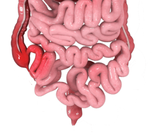 crohns-disease