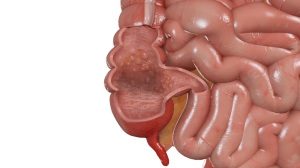 crohns-disease