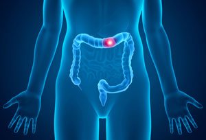 Colorectal Cancer Screening and Surveillance