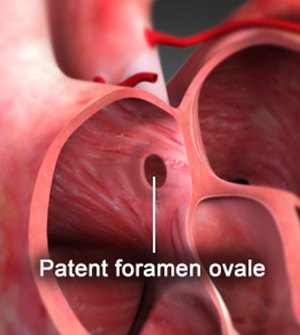 Congenital Heart Disease