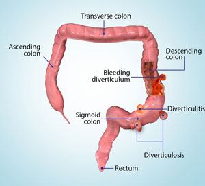 diverticular-disease