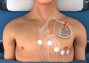 Insertion of Pacemakers