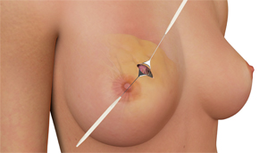 Oncoplastic Breast Surgery 