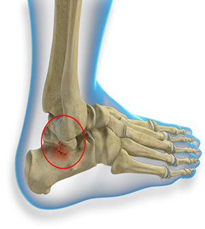 Pediatric Fractures