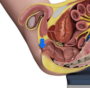 sphincterotomy