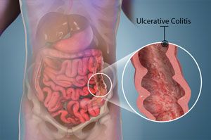 ulcerataive-colitis