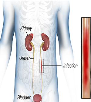 Urinary Tract Infection